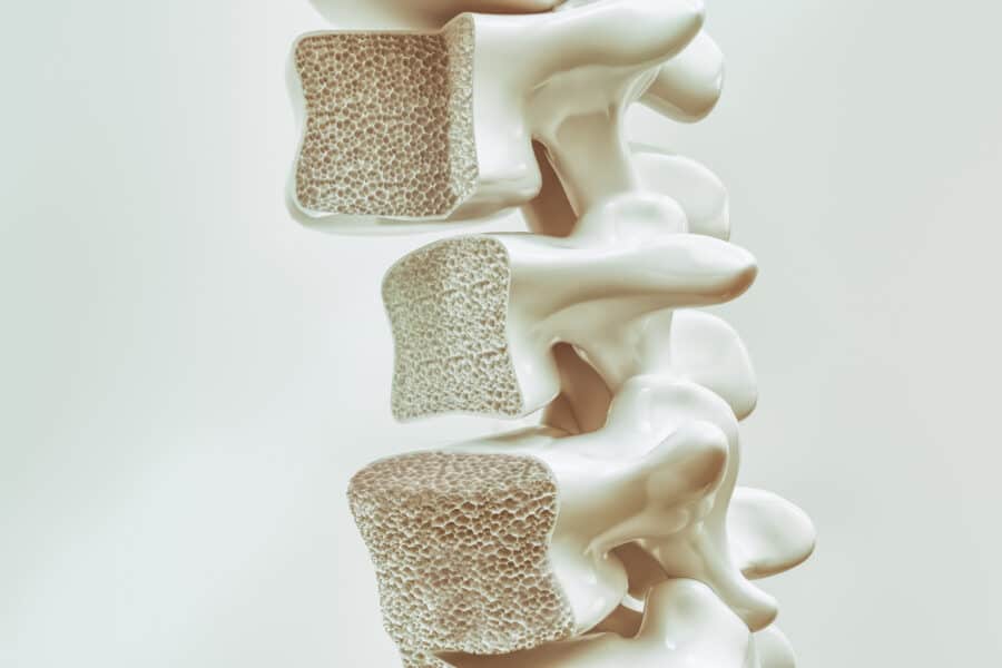 Osteoporose Colonne vertébrale - © iStock | CreVis2 Osteoporose Colonne vertébrale