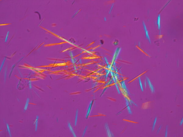 Gicht Fluorescent uric acid