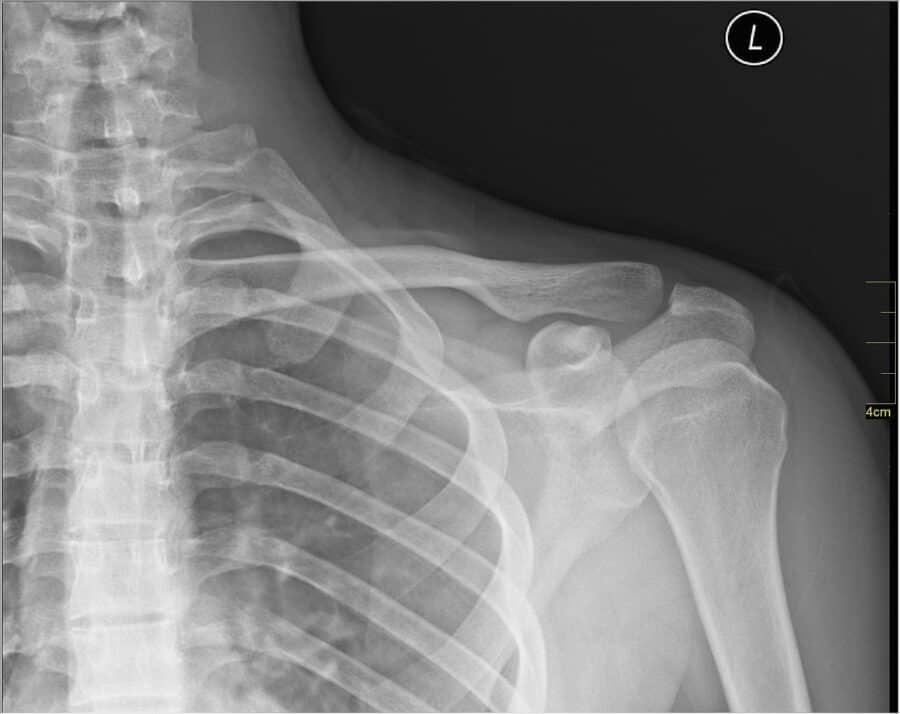 Radiographie de l'épaule - © Foto: Nevit Dilmen (Wikimedia Commons) Radiographie de l'épaule