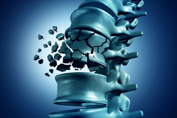 I Stock Osteoporose